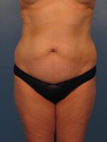 Tummy Tuck - Case 1029 - Before