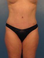 Tummy Tuck - Case 1029 - After
