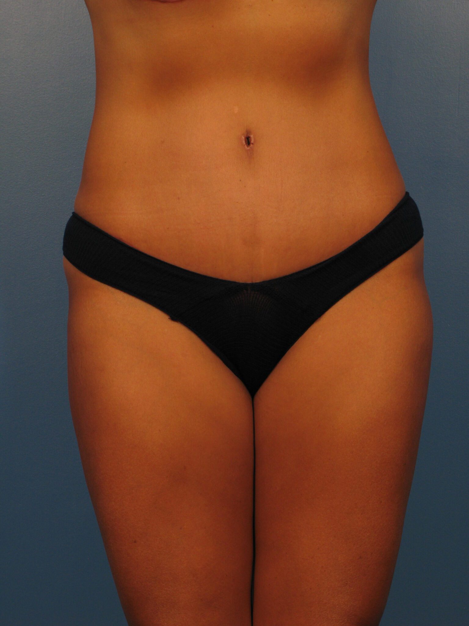 Tummy Tuck Patient Photo - Case 1000 - before view-1