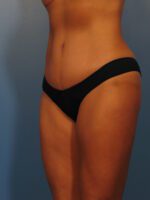 Tummy Tuck - Case 1000 - Before