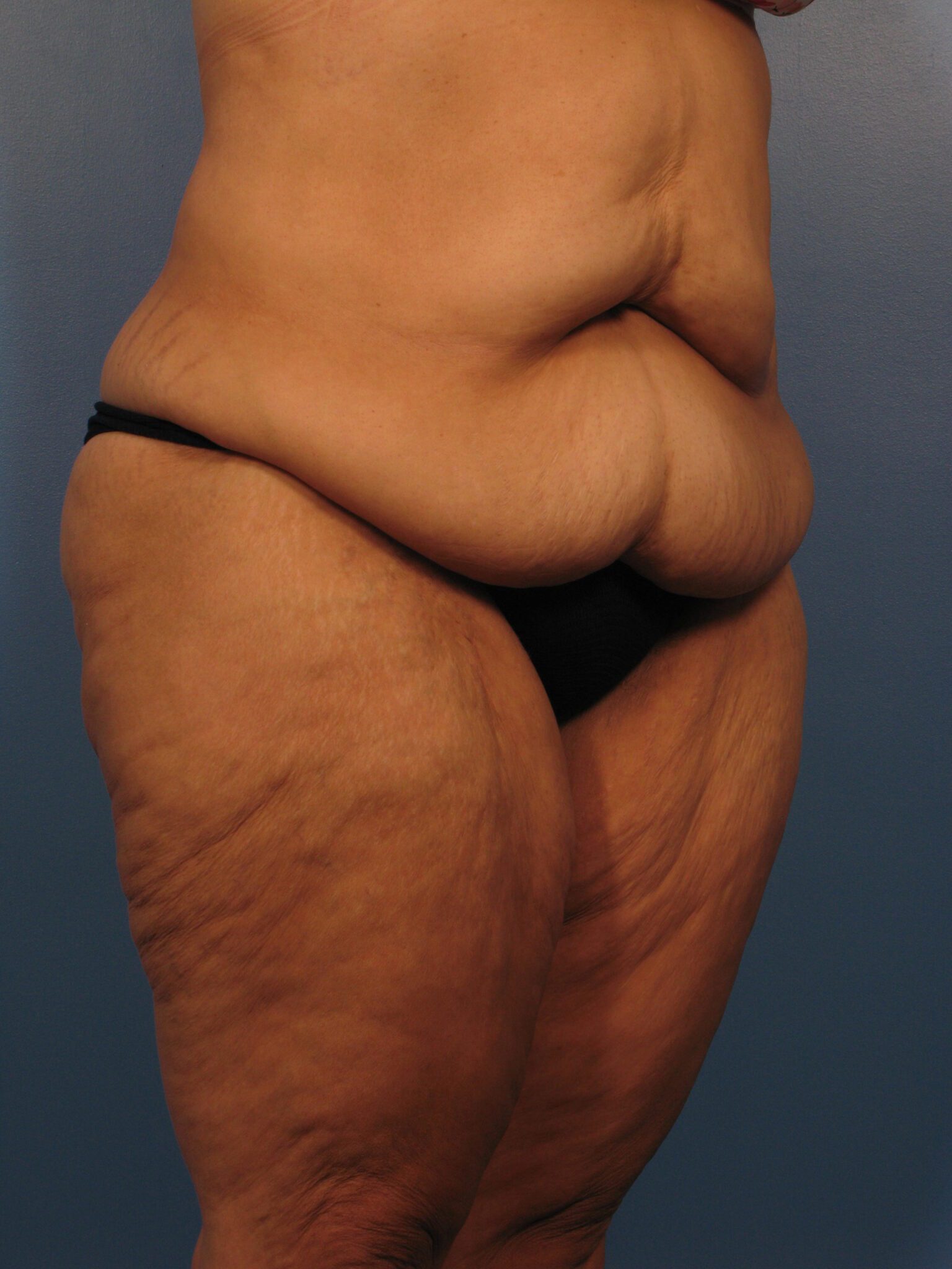 Belt Lipectomy Patient Photo - Case 1020 - after view-1