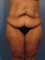 Belt Lipectomy - Case 1020 - Before