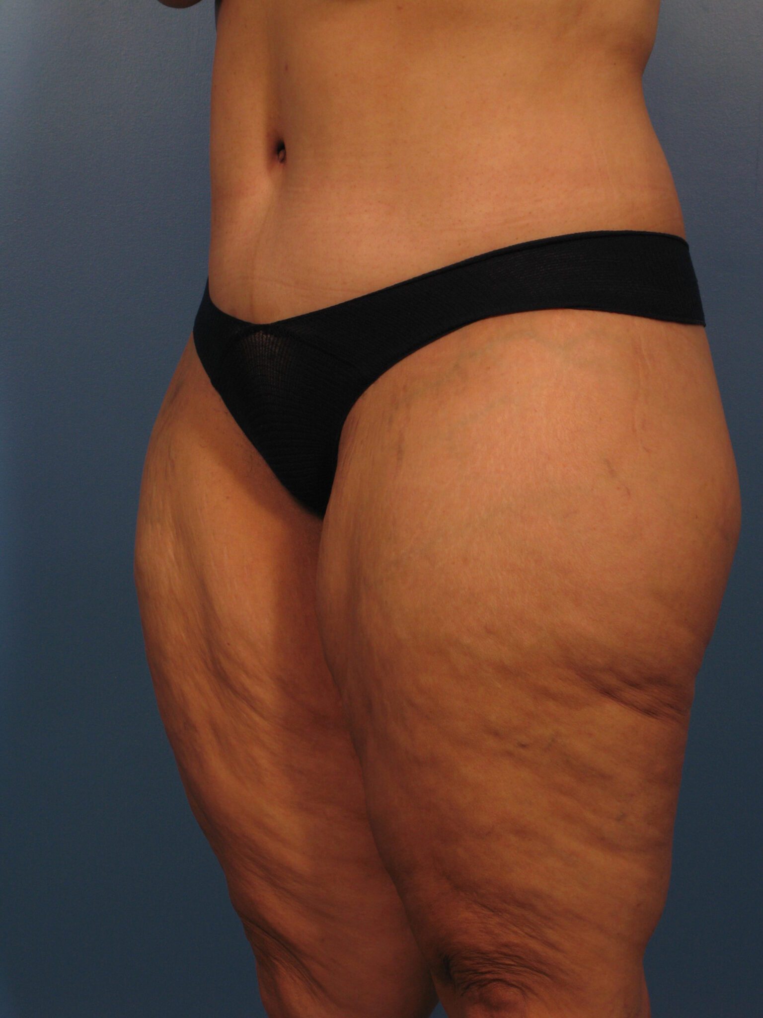 Belt Lipectomy Patient Photo - Case 1020 - before view-2