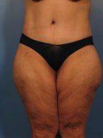 Belt Lipectomy - Case 1020 - After