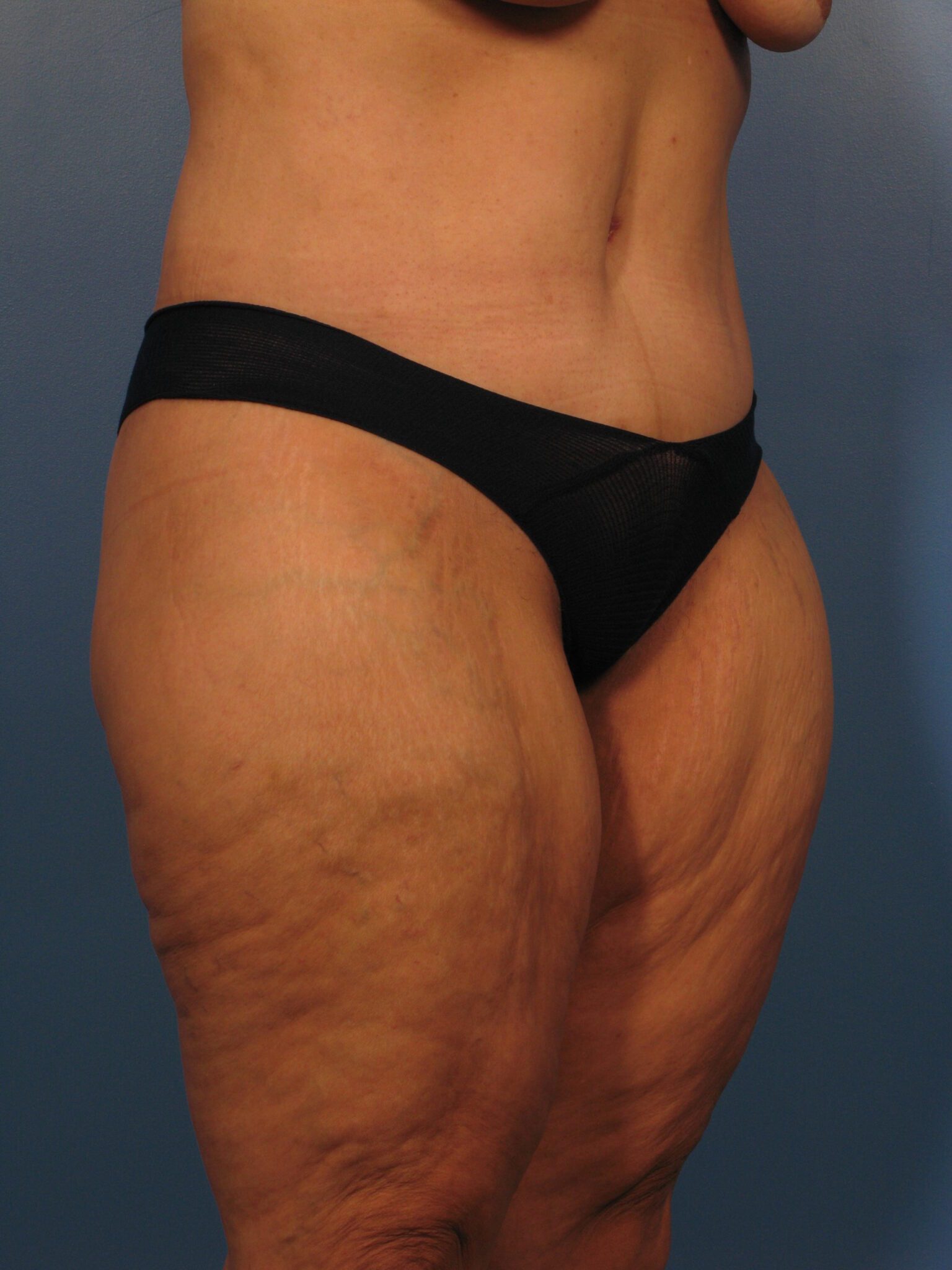 Belt Lipectomy Patient Photo - Case 1020 - before view-1