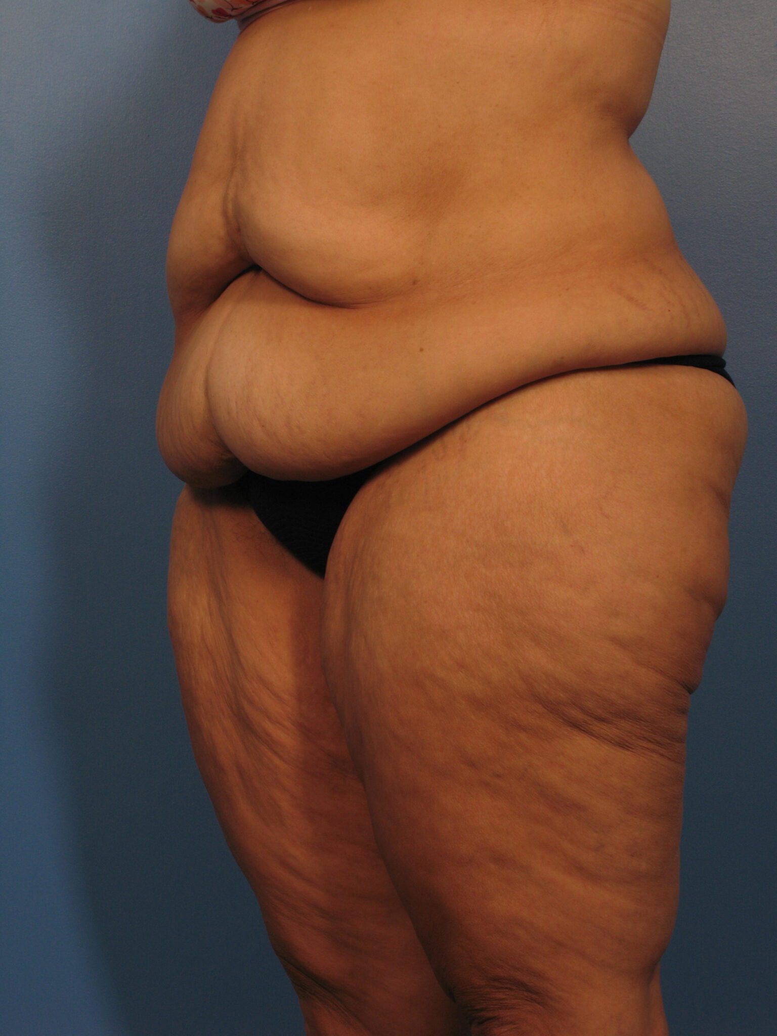 Belt Lipectomy Patient Photo - Case 1020 - after view-2