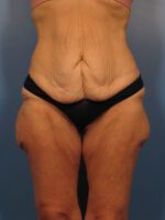 Belt Lipectomy - Case 1001 - Before