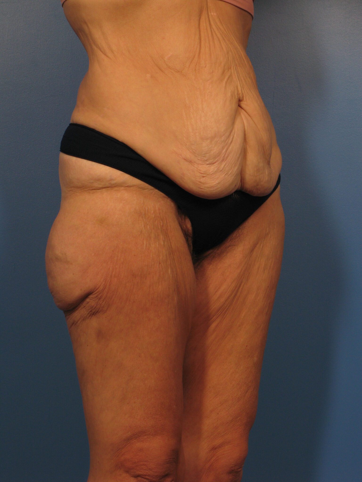 Belt Lipectomy Patient Photo - Case 1001 - before view-2