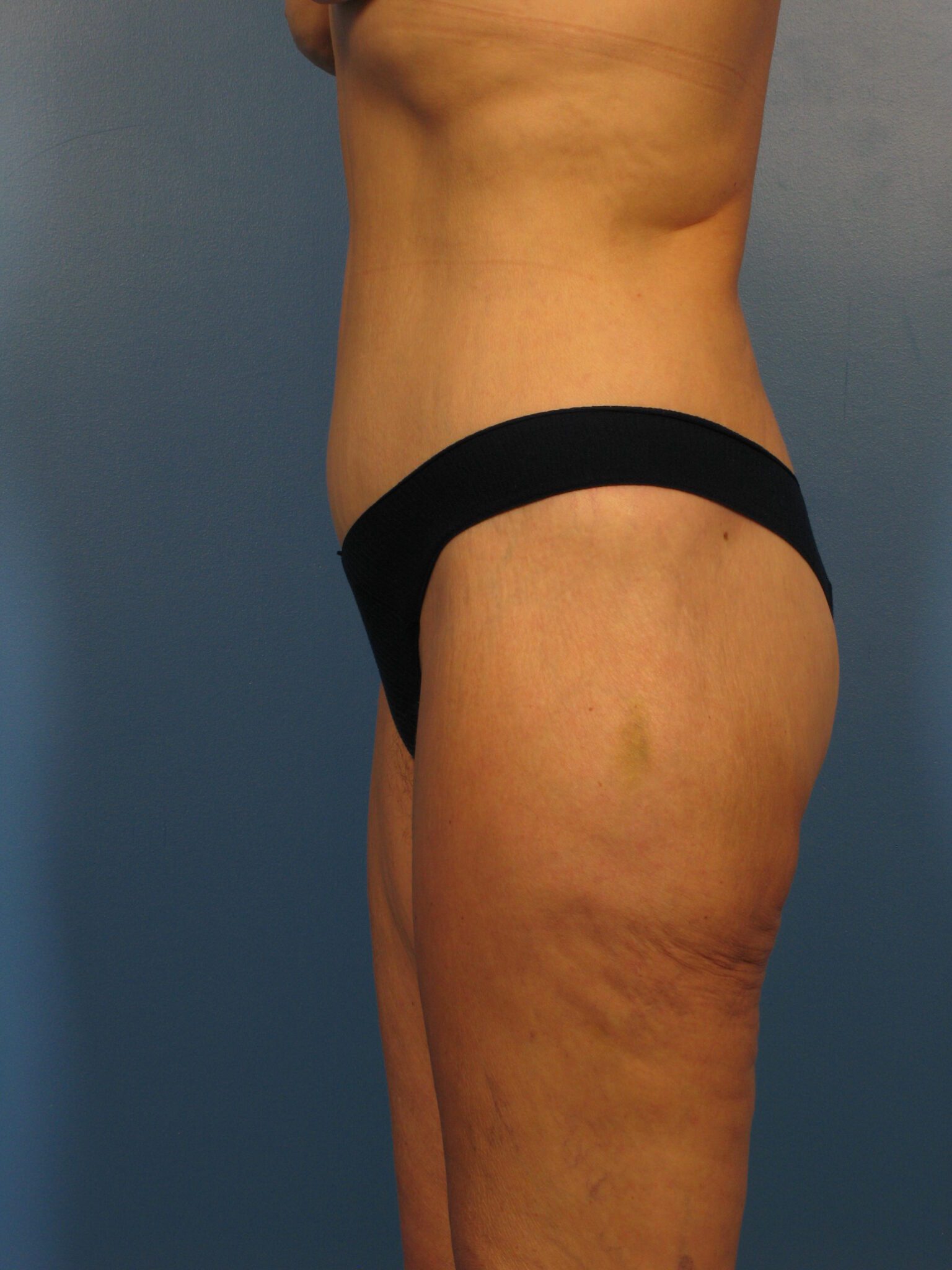 Belt Lipectomy Patient Photo - Case 1001 - after view-1