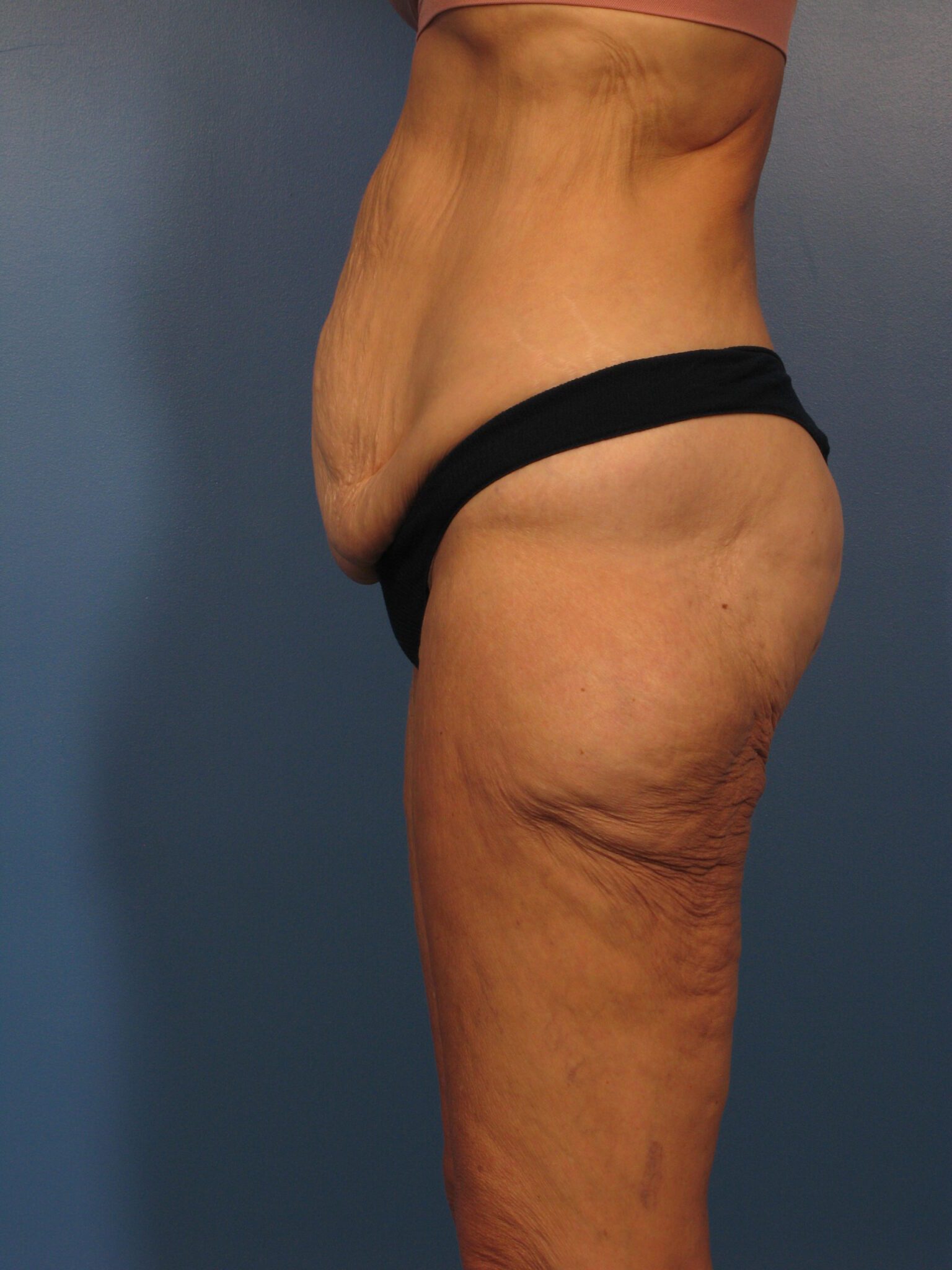 Belt Lipectomy Patient Photo - Case 1001 - before view-1
