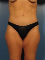 Belt Lipectomy - Case 1001 - After