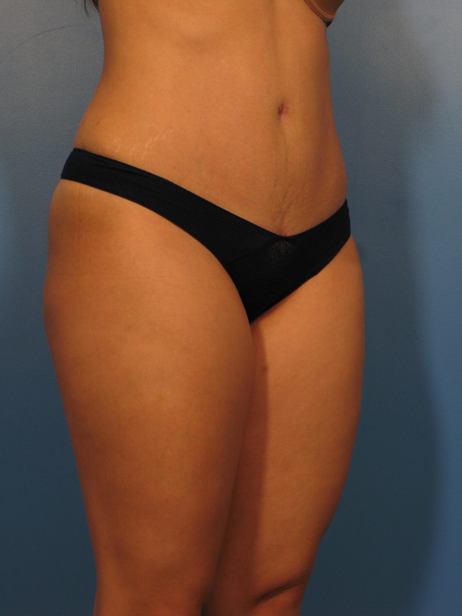 Tummy Tuck Patient Photo - Case 1002 - after view-2