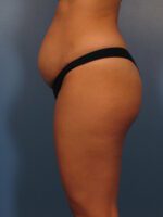Tummy Tuck - Case 1002 - Before