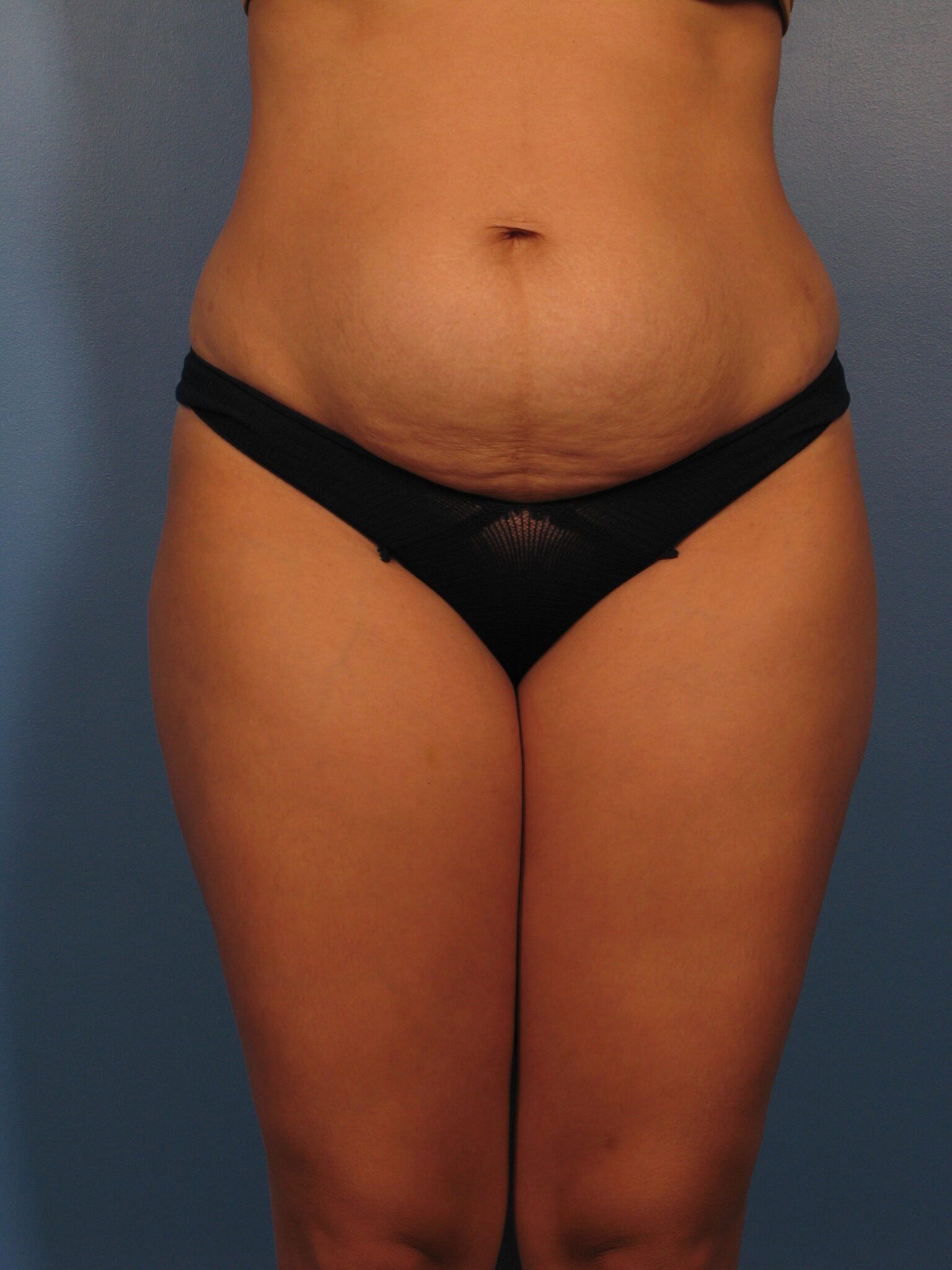 Tummy Tuck Patient Photo - Case 1002 - before view-1
