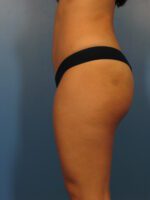 Tummy Tuck - Case 1002 - After