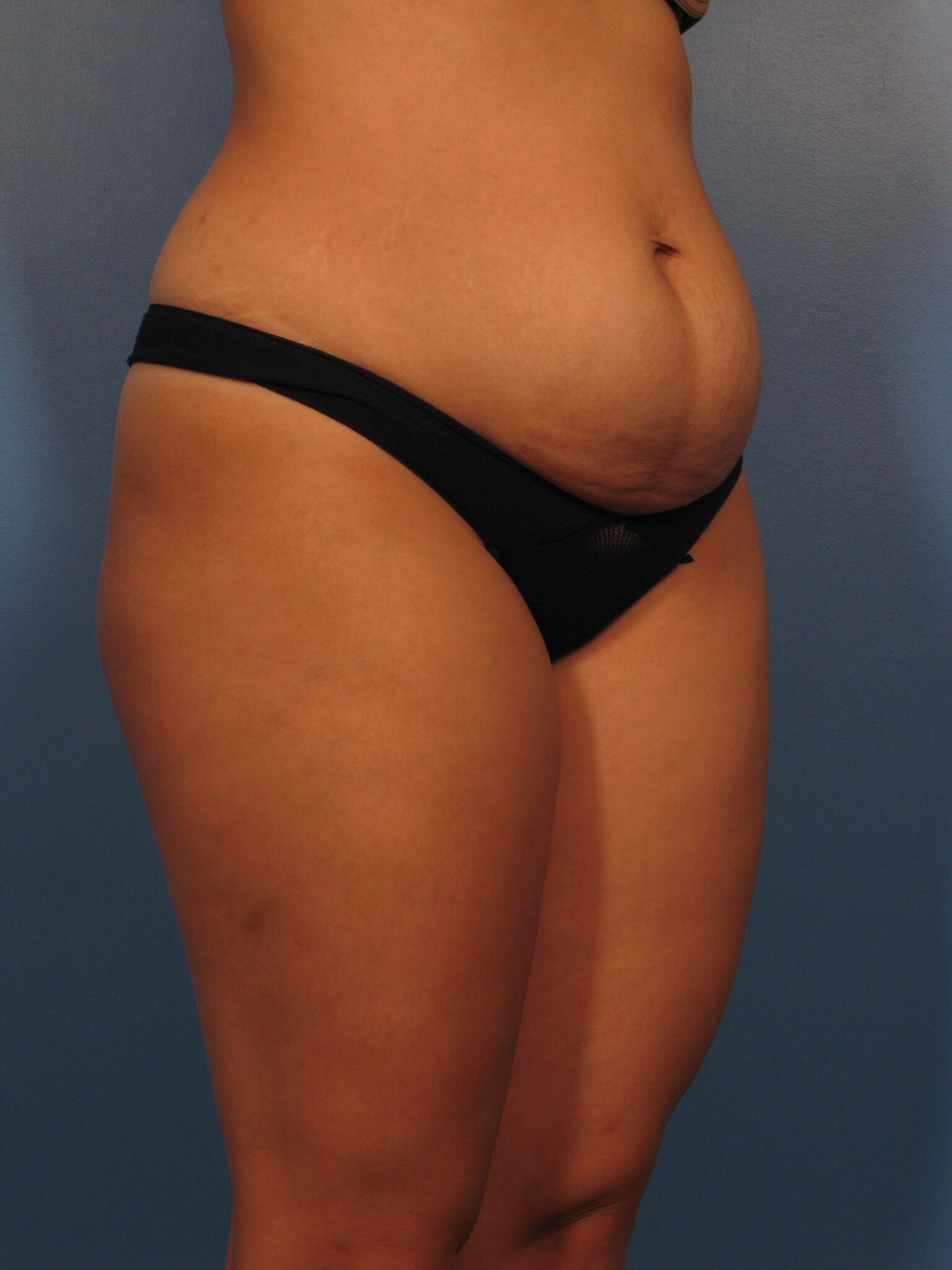 Tummy Tuck Patient Photo - Case 1002 - before view-2