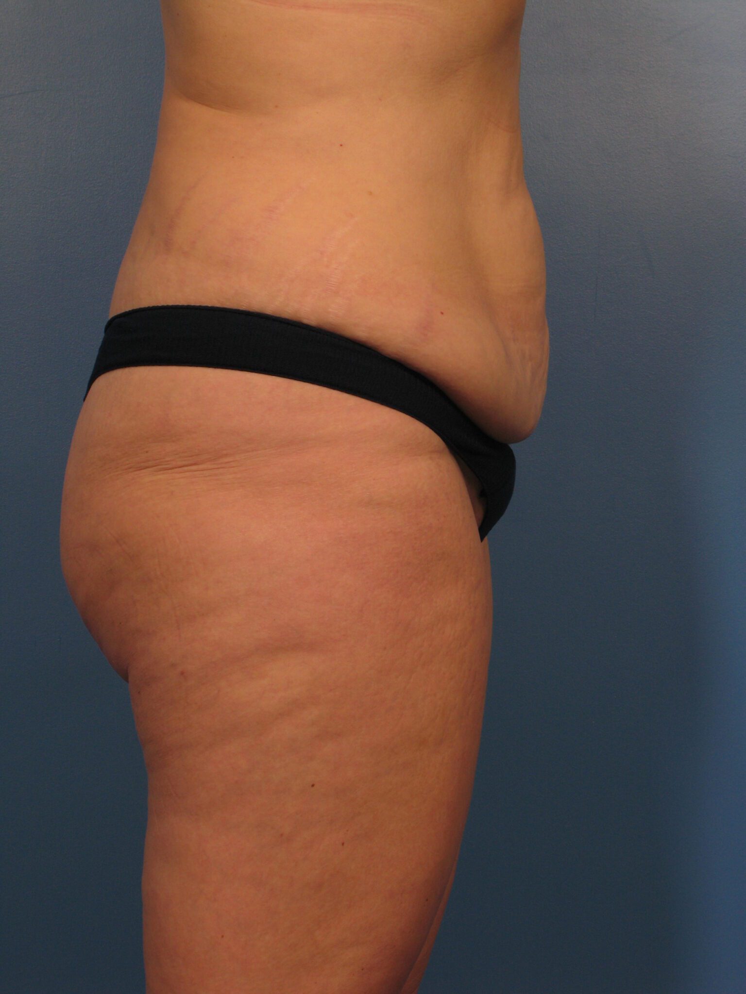 Tummy Tuck Patient Photo - Case 1003 - before view-2