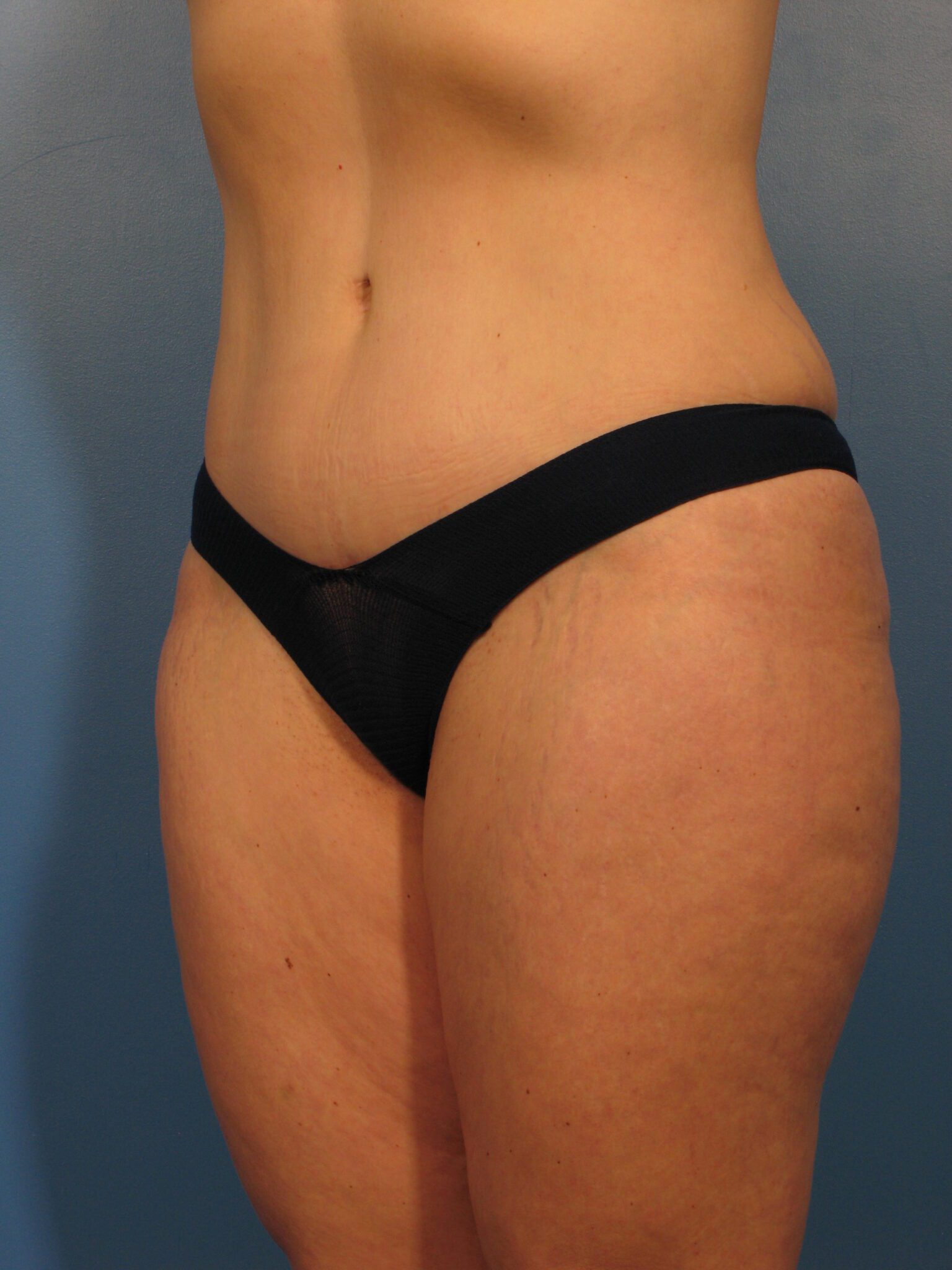Tummy Tuck Patient Photo - Case 1003 - after view-1