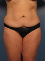 Tummy Tuck - Case 1003 - Before