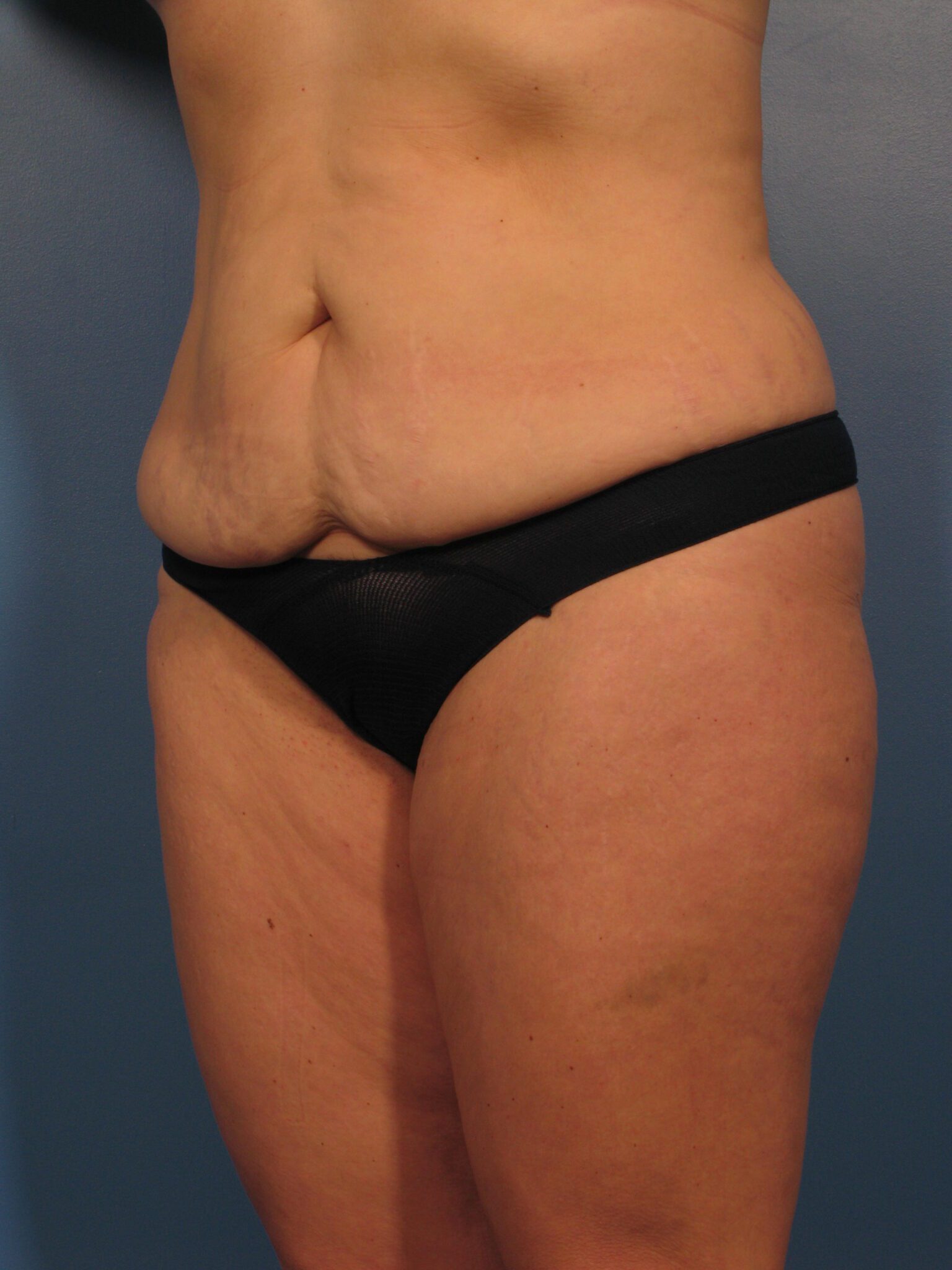 Tummy Tuck Patient Photo - Case 1003 - before view-1
