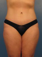 Tummy Tuck - Case 1003 - After