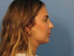 Chin Contouring - Case 1009 - After