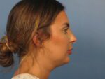 Chin Contouring - Case 1009 - Before
