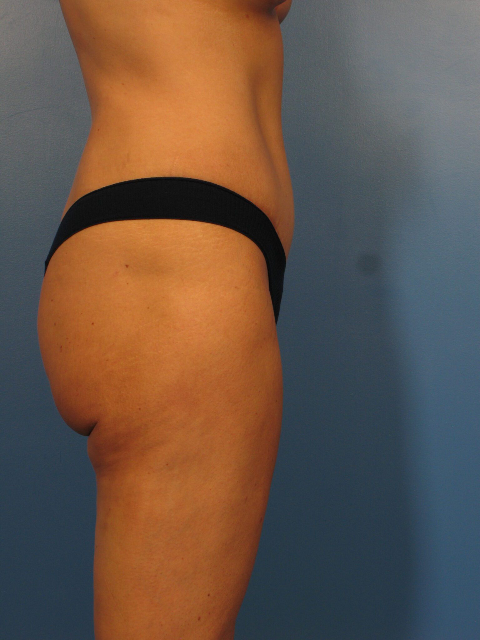 Tummy Tuck Patient Photo - Case 1004 - after view-1