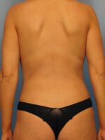 Liposuction - Case 1006 - After