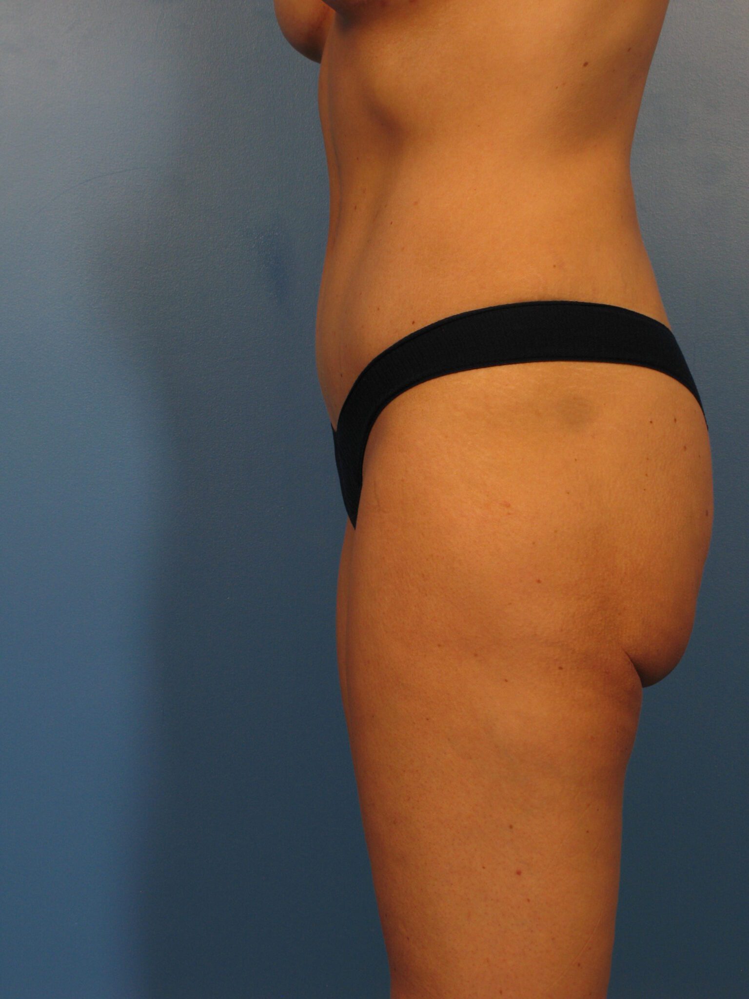 Tummy Tuck Patient Photo - Case 1004 - after view-2