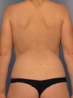 Liposuction - Case 1006 - Before