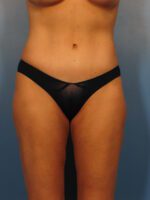 Tummy Tuck - Case 1004 - After