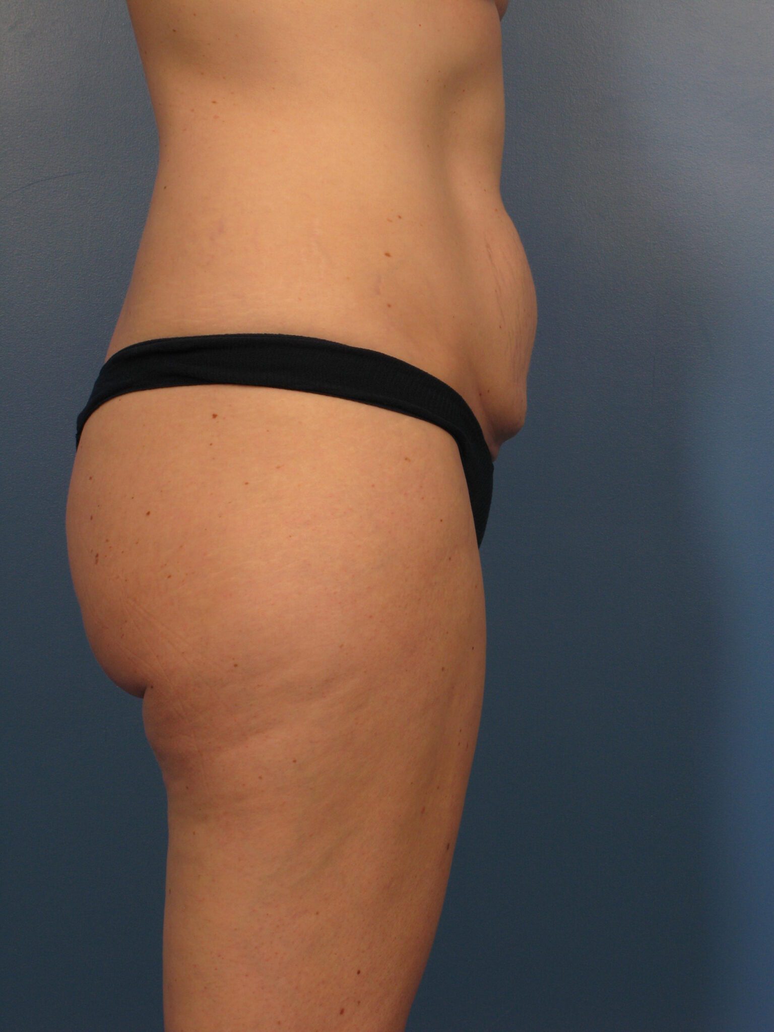 Tummy Tuck Patient Photo - Case 1004 - before view-1