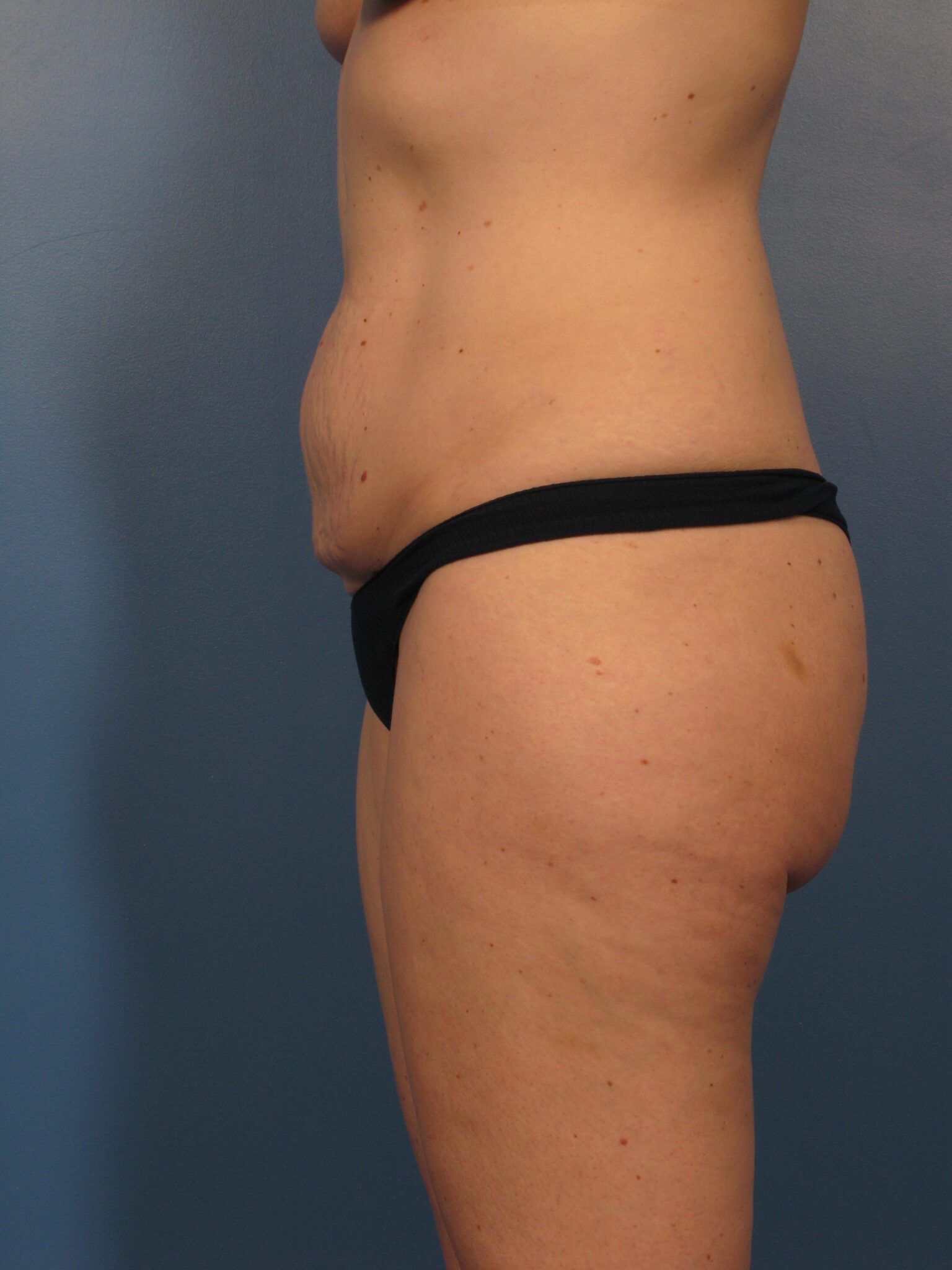 Tummy Tuck Patient Photo - Case 1004 - before view-2