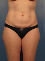 Tummy Tuck - Case 1004 - Before