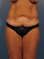 Belt Lipectomy - Case 1013 - Before
