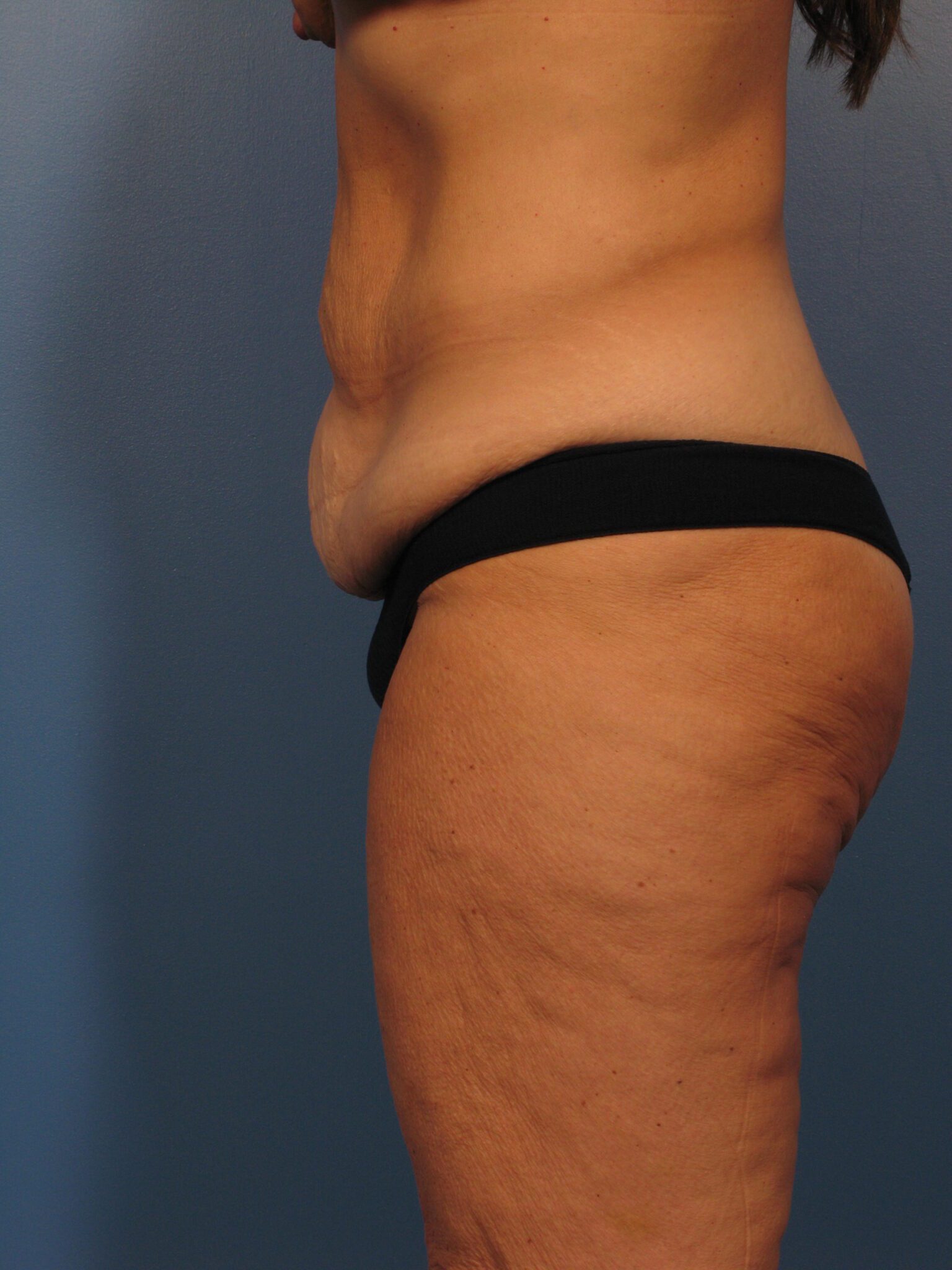 Belt Lipectomy Patient Photo - Case 1013 - before view-2