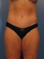Belt Lipectomy - Case 1013 - After