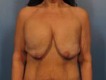 Breast Augmentation with Lift - Case 1012 - Before
