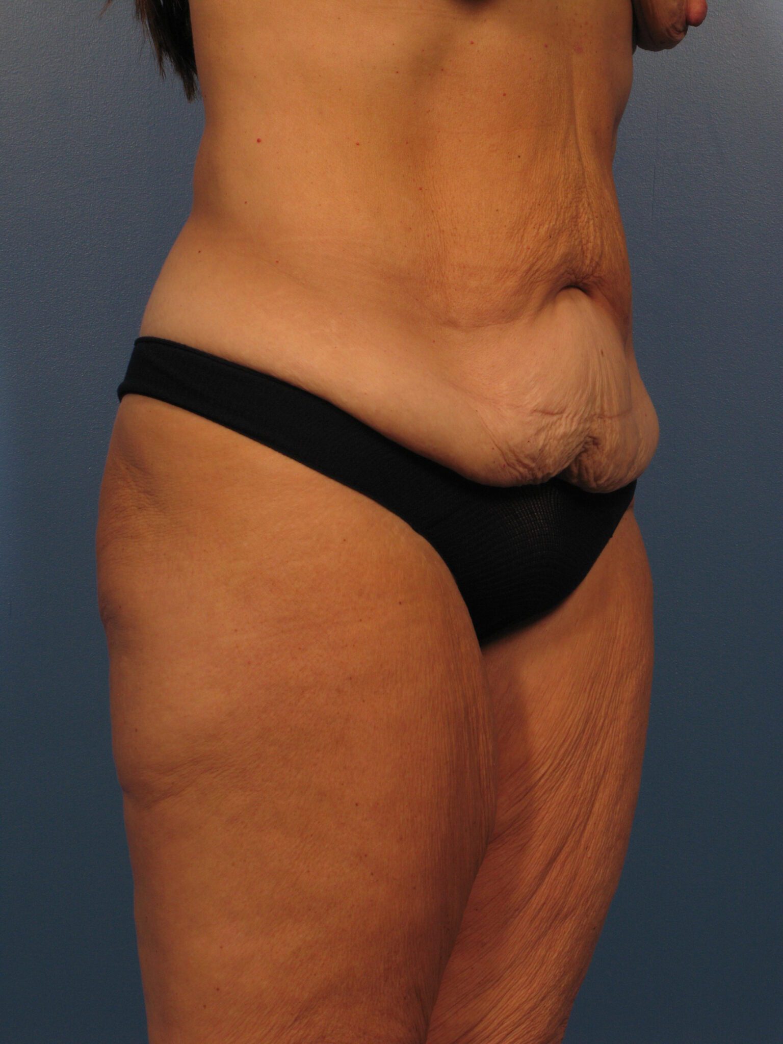 Belt Lipectomy Patient Photo - Case 1013 - before view-1