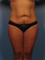 Tummy Tuck - Case 1019 - Before