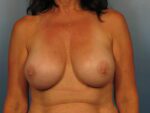 Breast Revision - Case 1035 - After
