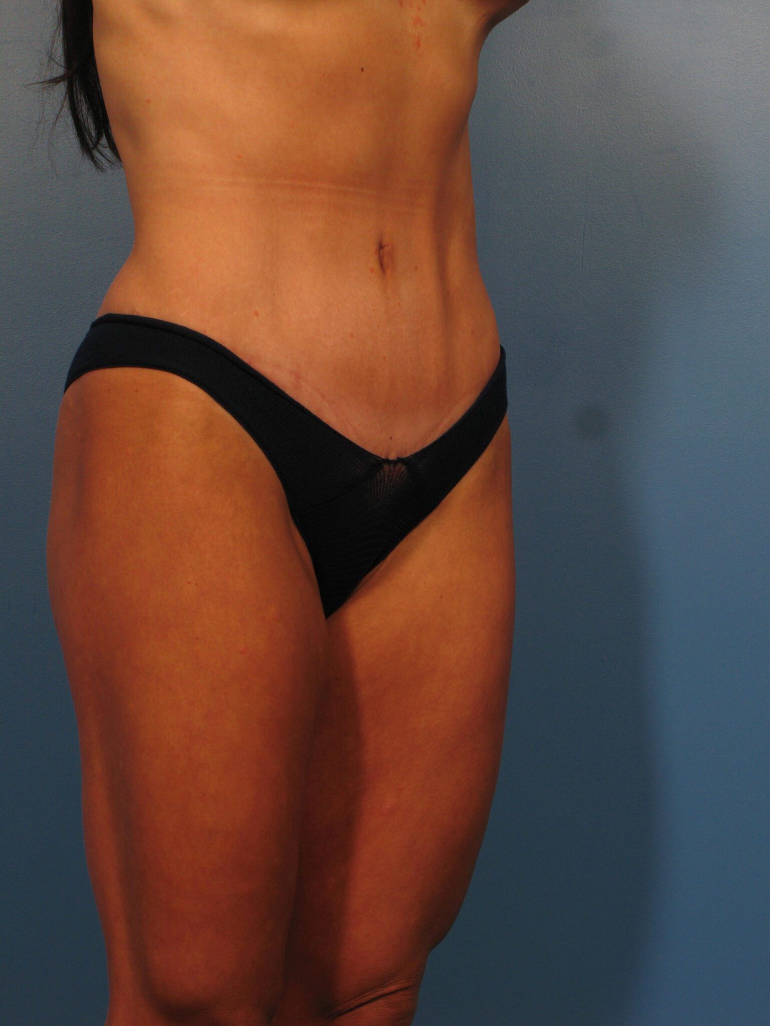 Tummy Tuck Patient Photo - Case 1039 - before view-2