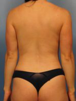 Liposuction - Case 1038 - After