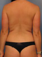 Liposuction - Case 1038 - Before