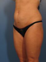Tummy Tuck - Case 1037 - Before