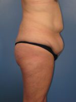 Belt Lipectomy - Case 1047b - Before