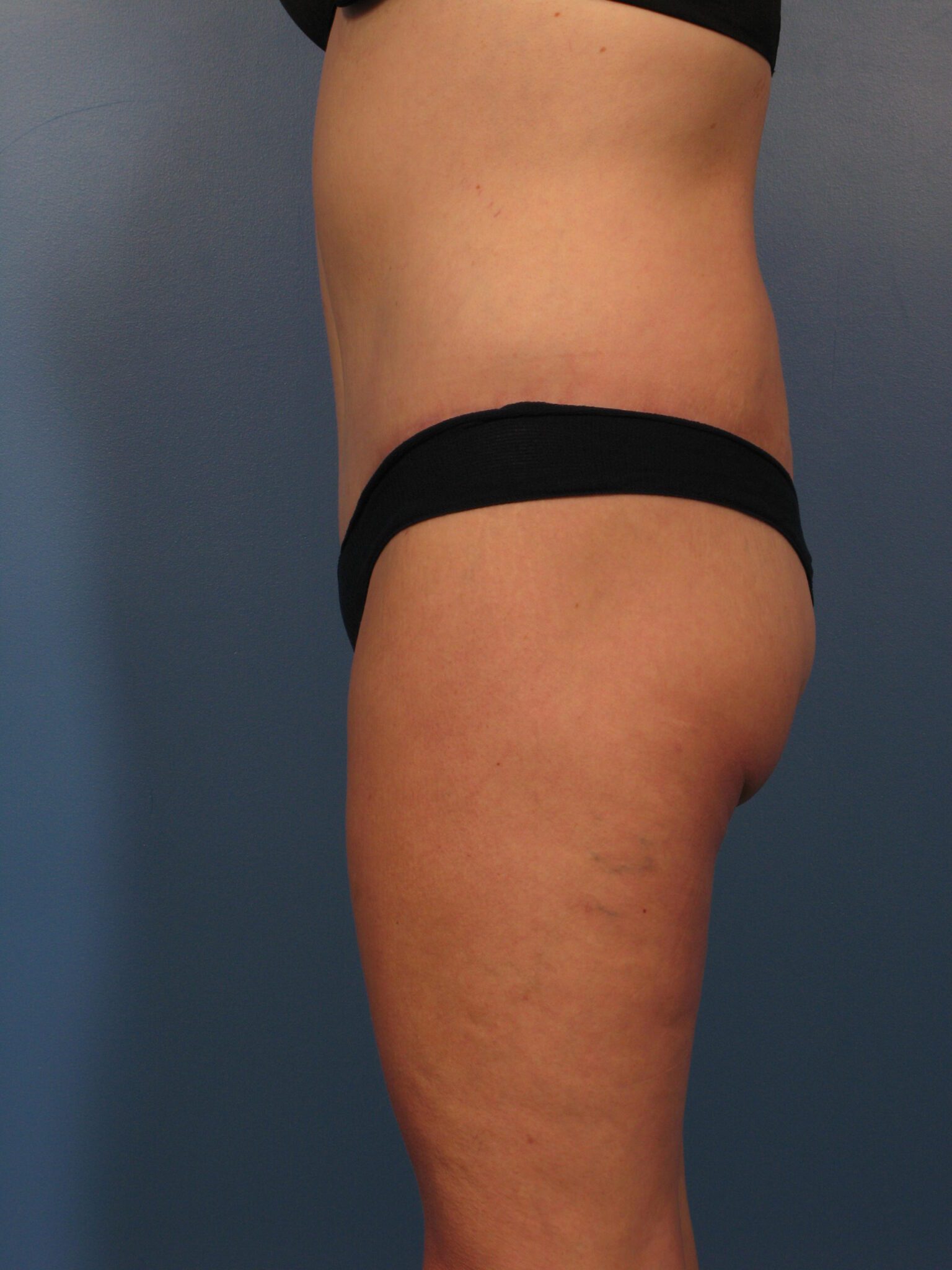 Belt Lipectomy Patient Photo - Case 1047b - after view-1