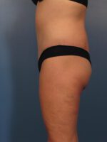 After Major Weight Loss - Case 1047a - After
