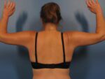 Arm, Thigh and Butt Lift - Case 1047 - After